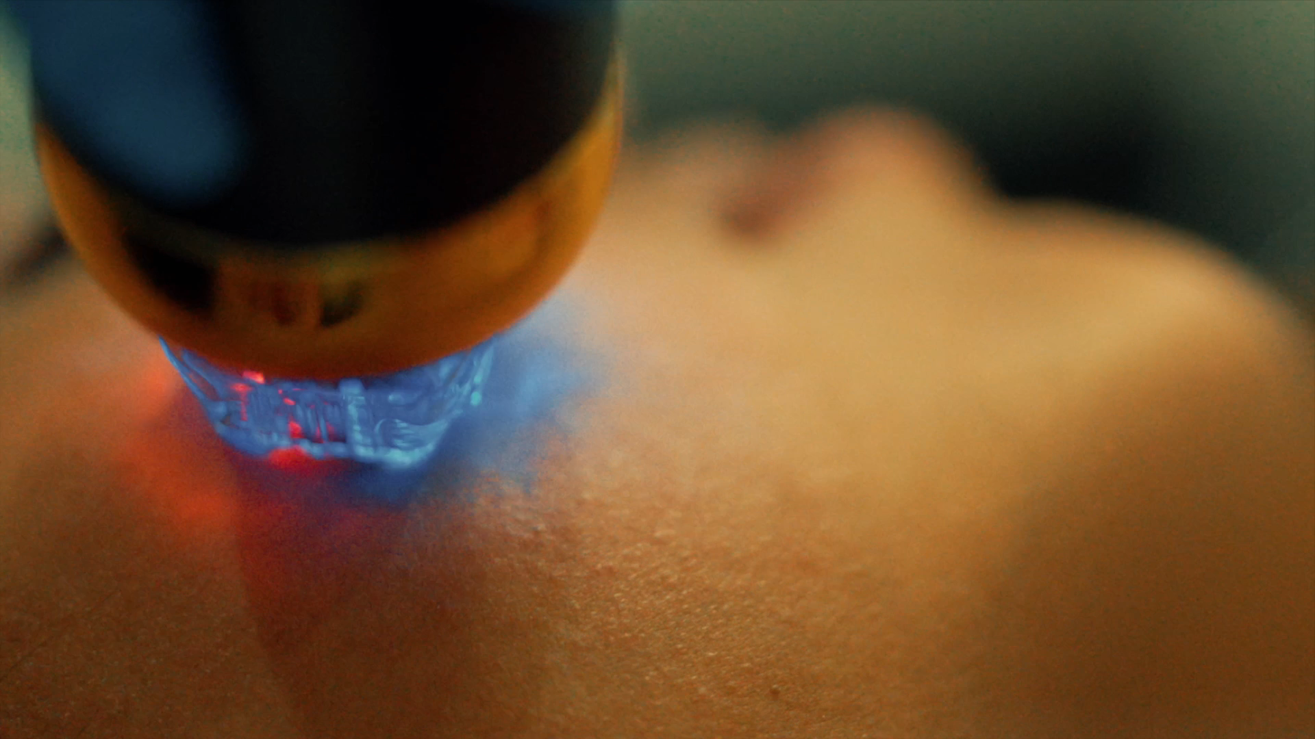 RF Microneedling